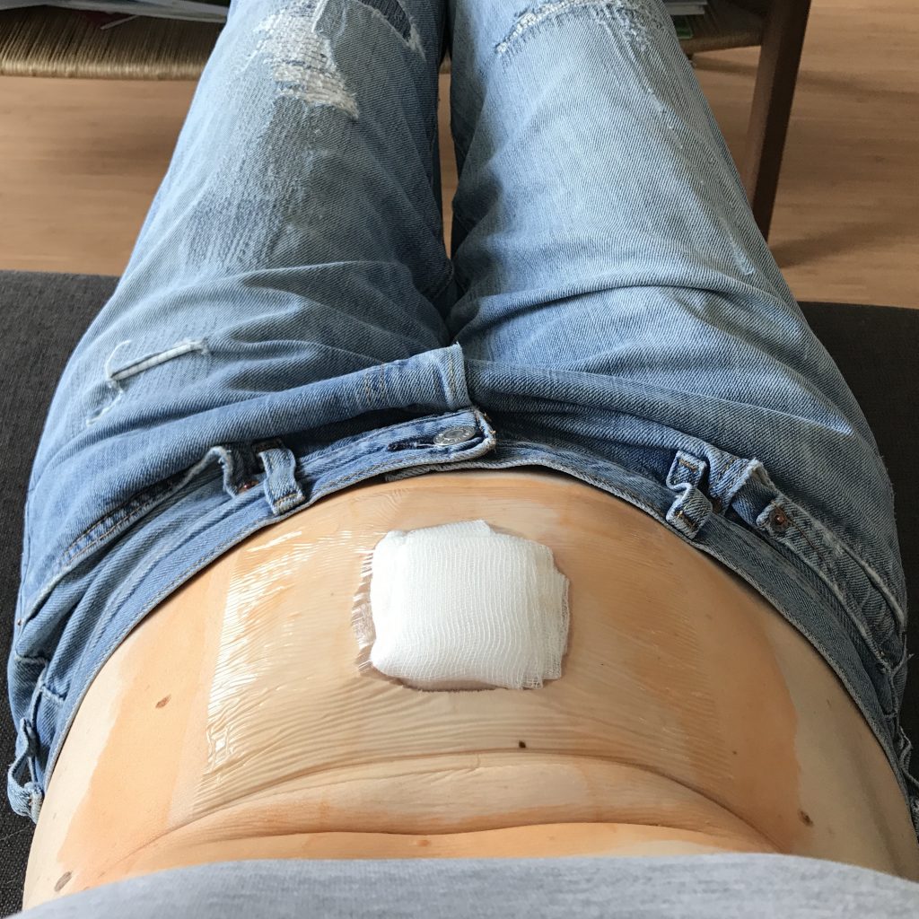 Nach Nabelbruch Op Auf Der Seite Schlafen Nabelbruch-OP? Och nö, da hab ich doch keine Zeit für! - LÄCHELN UND WINKEN