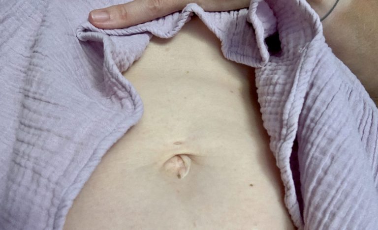 Wie Sieht Der Nabel Aus Wenn Er Abfällt Nabelbruch-OP? Och nö, da hab ich doch keine Zeit für! - LÄCHELN UND WINKEN